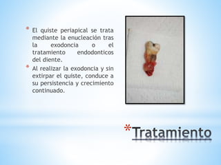 *
* El quiste periapical se trata
mediante la enucleación tras
la exodoncia o el
tratamiento endodonticos
del diente.
* Al realizar la exodoncia y sin
extirpar el quiste, conduce a
su persistencia y crecimiento
continuado.
 