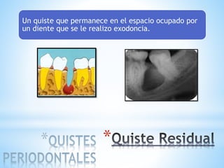 *
Un quiste que permanece en el espacio ocupado por
un diente que se le realizo exodoncia.
 