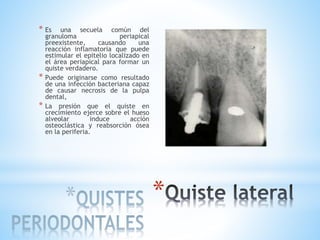 *
* Es una secuela común del
granuloma periapical
preexistente, causando una
reacción inflamatoria que puede
estimular el epitelio localizado en
el área periapical para formar un
quiste verdadero.
* Puede originarse como resultado
de una infección bacteriana capaz
de causar necrosis de la pulpa
dental,
* La presión que el quiste en
crecimiento ejerce sobre el hueso
alveolar induce acción
osteoclástica y reabsorción ósea
en la periferia.
 