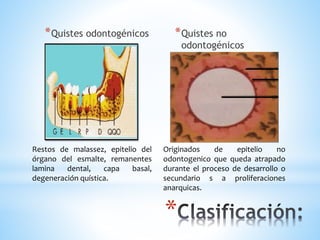 *
*Quistes odontogénicos *Quistes no
odontogénicos
Restos de malassez, epitelio del
órgano del esmalte, remanentes
lamina dental, capa basal,
degeneración quística.
Originados de epitelio no
odontogenico que queda atrapado
durante el proceso de desarrollo o
secundario s a proliferaciones
anarquicas.
 