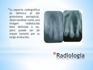 *
*Su aspecto radiográfico
es idéntico al del
granuloma periapical,
observándose como una
imagen radiolúcida
bien definida o no,
pero puede ser de
mayor tamaño por su
larga evolución.
 