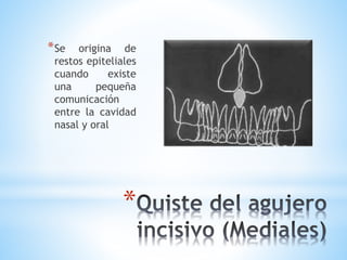 *
*Se origina de
restos epiteliales
cuando existe
una pequeña
comunicación
entre la cavidad
nasal y oral
 