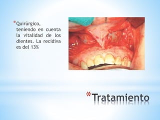 *
*Quirúrgico,
teniendo en cuenta
la vitalidad de los
dientes. La recidiva
es del 13%
 