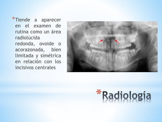 *
*Tiende a aparecer
en el examen de
rutina como un área
radiolúcida
redonda, ovoide o
acorazonada, bien
limitada y simétrica
en relación con los
incisivos centrales
 