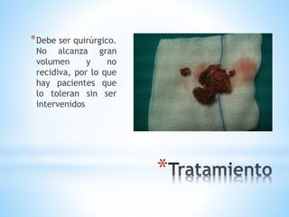 *
*Debe ser quirúrgico.
No alcanza gran
volumen y no
recidiva, por lo que
hay pacientes que
lo toleran sin ser
intervenidos
 