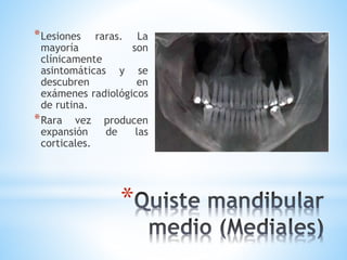 *
*Lesiones raras. La
mayoría son
clínicamente
asintomáticas y se
descubren en
exámenes radiológicos
de rutina.
*Rara vez producen
expansión de las
corticales.
 