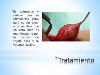 *
*Es quirúrgico y
radical con su
eliminación total
para no dar lugar
a la recidiva que
en esta área es
mas frecuente por
la calidad de
tejido óseo y la
vascularización.
 