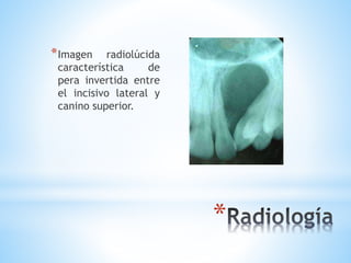 *
*Imagen radiolúcida
característica de
pera invertida entre
el incisivo lateral y
canino superior.
 