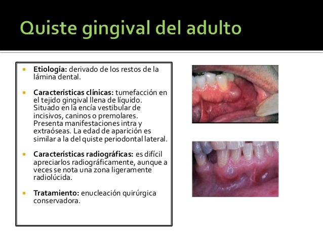 Quistes de la región oral