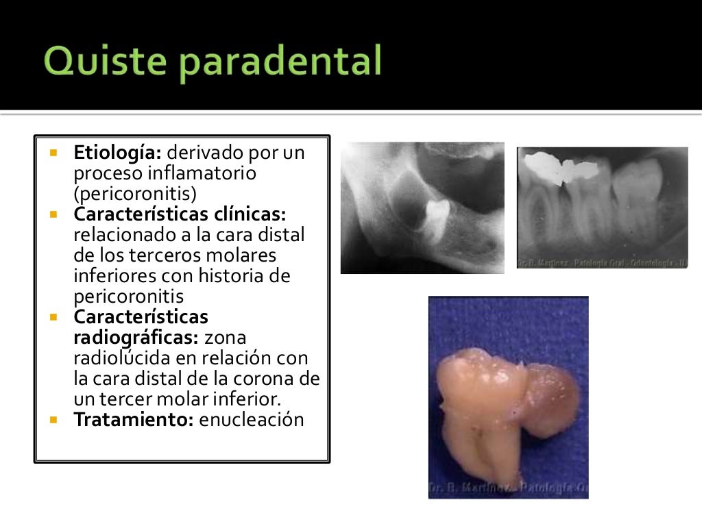 Quistes de la región oral Quistes de la región oral
