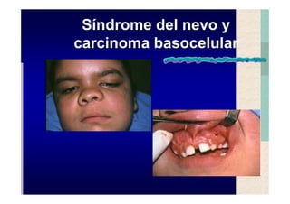 Quistes de la region maxilofacial