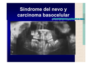 Quistes de la region maxilofacial