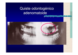 Quistes de la region maxilofacial