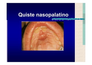 Quistes de la region maxilofacial