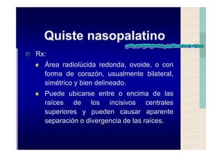 Quistes de la region maxilofacial