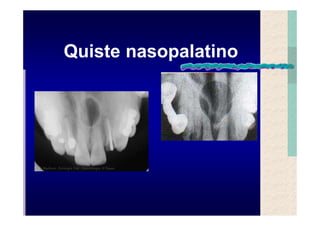 Quistes de la region maxilofacial
