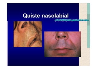 Quistes de la region maxilofacial