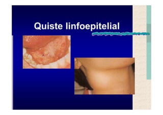 Quistes de la region maxilofacial