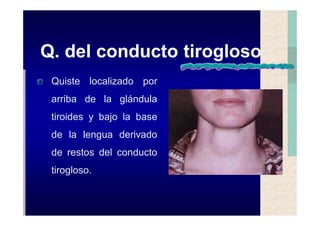 Quistes de la region maxilofacial
