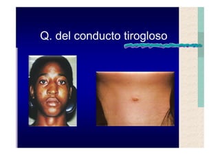 Quistes de la region maxilofacial