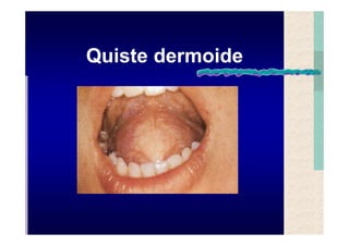 Quistes de la region maxilofacial