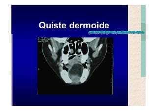 Quistes de la region maxilofacial
