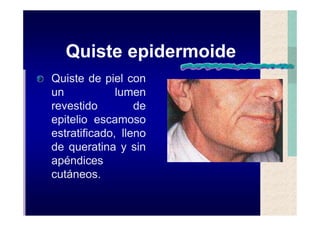 Quistes de la region maxilofacial