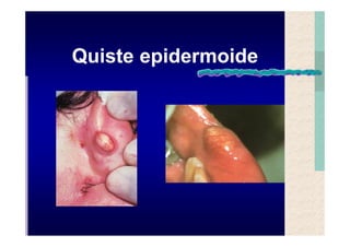 Quistes de la region maxilofacial