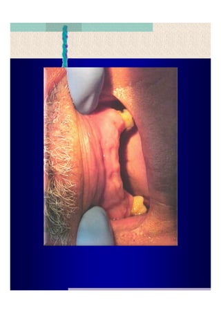 Quistes de la region maxilofacial