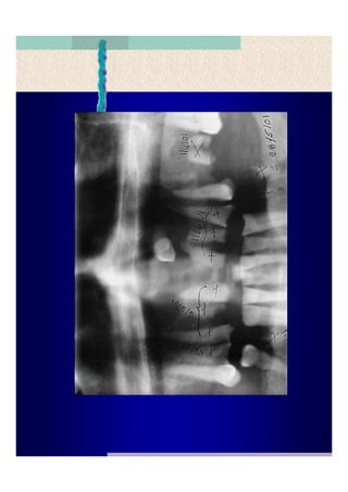 Quistes de la region maxilofacial