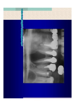 Quistes de la region maxilofacial