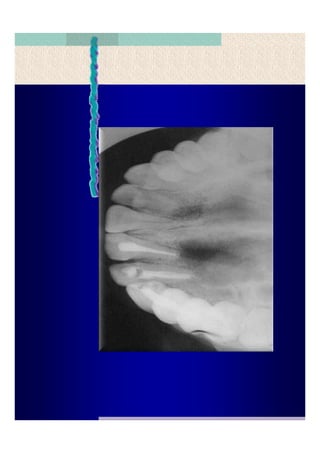 Quistes de la region maxilofacial