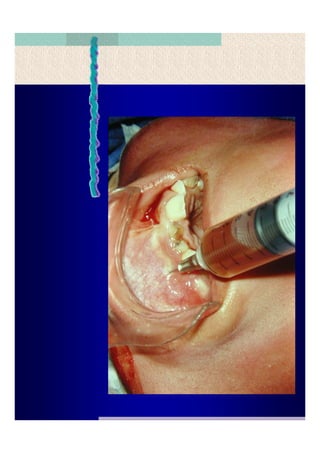 Quistes de la region maxilofacial