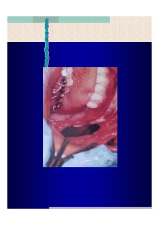 Quistes de la region maxilofacial