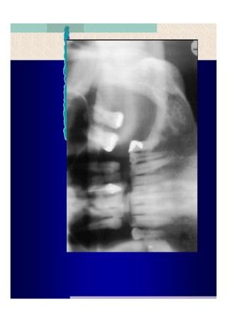 Quistes de la region maxilofacial
