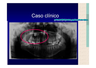 Quistes de la region maxilofacial