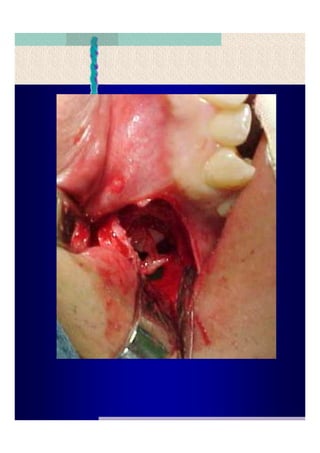 Quistes de la region maxilofacial