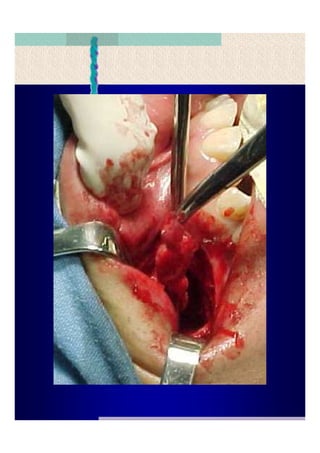 Quistes de la region maxilofacial