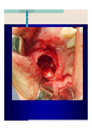 Quistes de la region maxilofacial