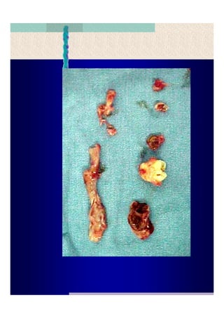 Quistes de la region maxilofacial