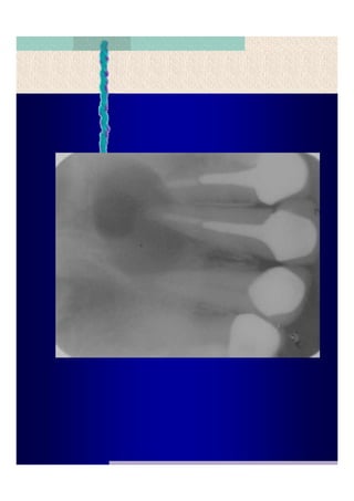 Quistes de la region maxilofacial