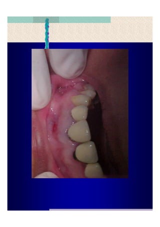 Quistes de la region maxilofacial