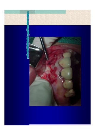 Quistes de la region maxilofacial