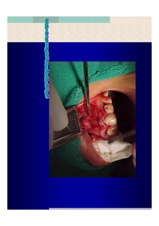 Quistes de la region maxilofacial