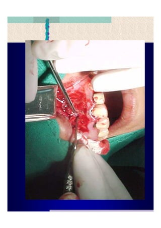 Quistes de la region maxilofacial