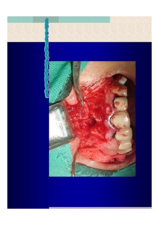 Quistes de la region maxilofacial