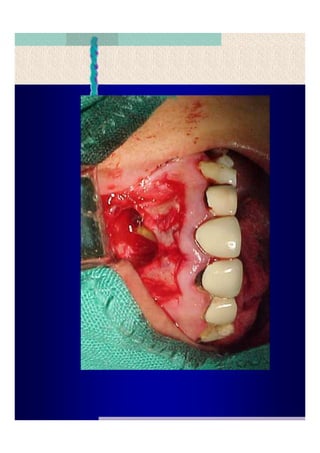 Quistes de la region maxilofacial