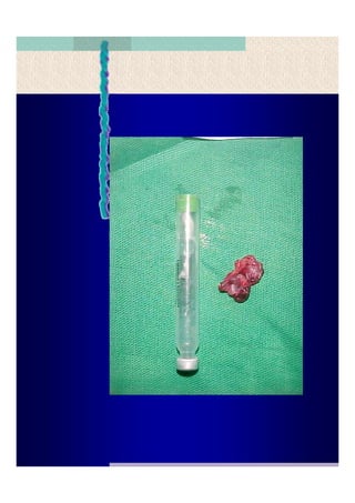 Quistes de la region maxilofacial