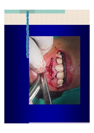 Quistes de la region maxilofacial