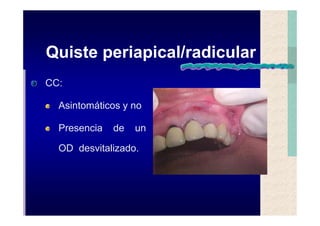 Quistes de la region maxilofacial